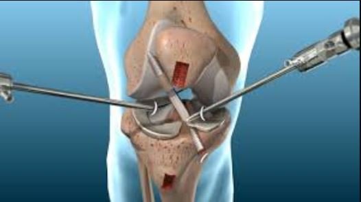 ACL Surgery